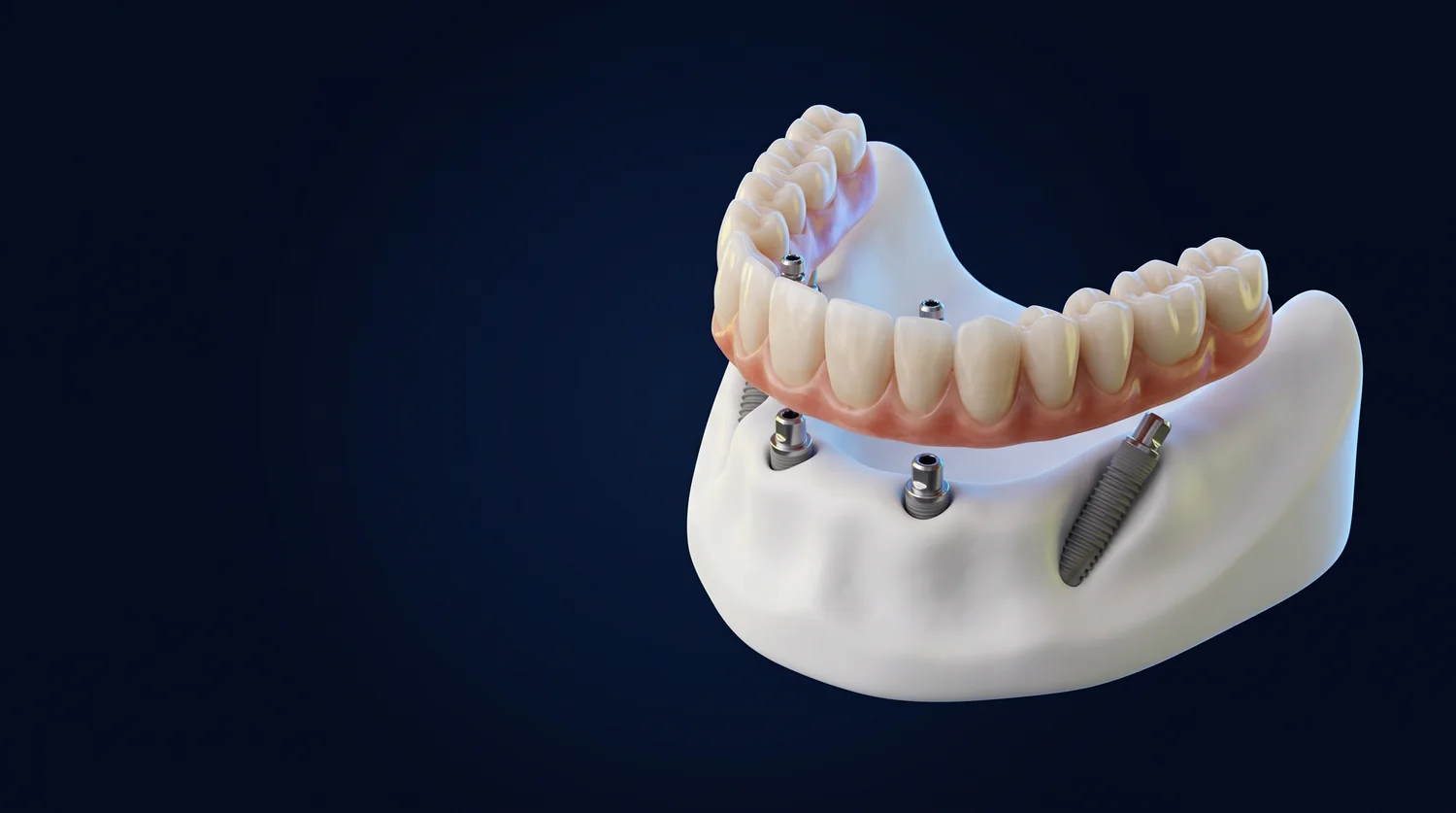 Ilustração 3D de uma arcada fixa sobre quatro implantes